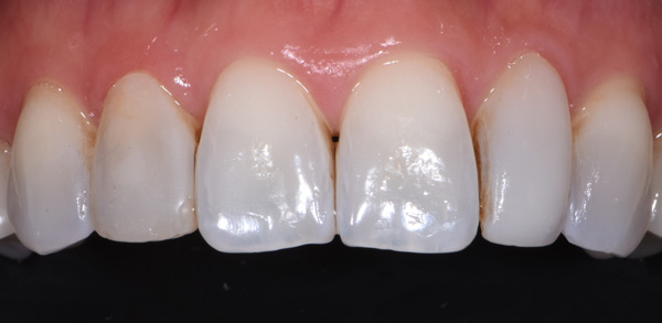 Photo of mouth before bioclear veneers.