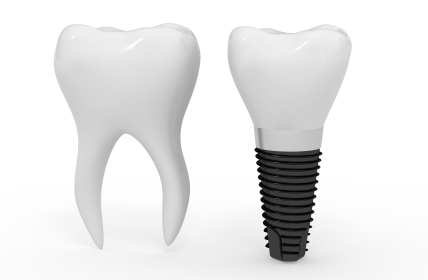 3d rendering of a dental implant next to a tooth