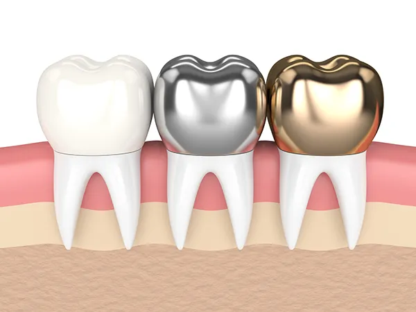3D rendered cross-section view of three teeth with dental crowns made of different materials at San Francisco Dental Arts in San Francisco, CA