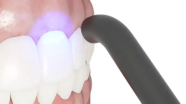 Close-up of a dental bonding procedure using a curing light to harden the composite material on a patient's teeth.