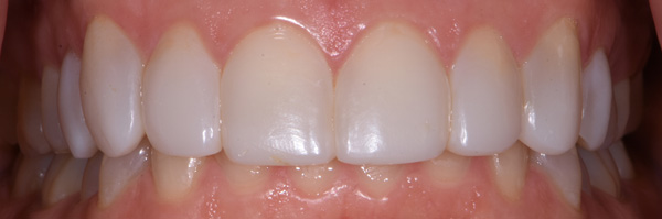 Photo of mouth after bioclear veneers.