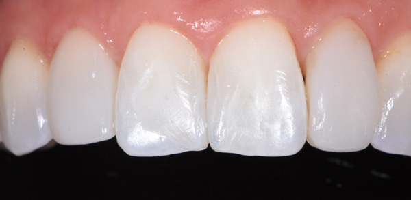 Photo of mouth after bioclear veneers.