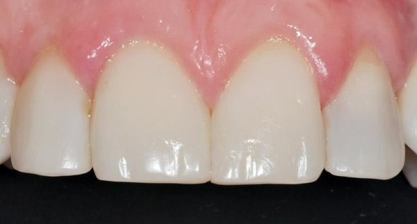 Photo of mouth after bioclear veneers.