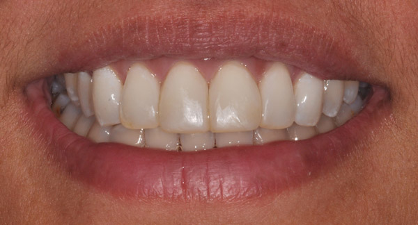 Photo of mouth after bioclear veneers.