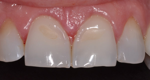 Photo of mouth before bioclear veneers.