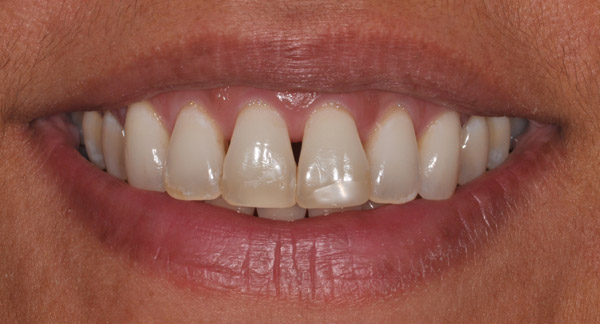 Photo of mouth before bioclear veneers.