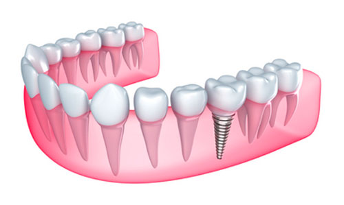 Who Is A Candidate For Dental Implant?