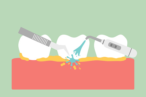 A 3d rendering of the process of teeth cleaning