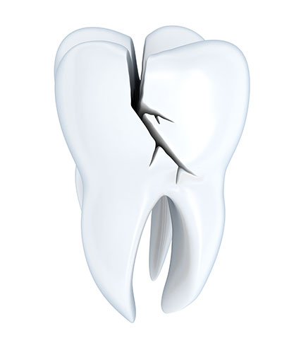 A 3D rendering of a cracked tooth