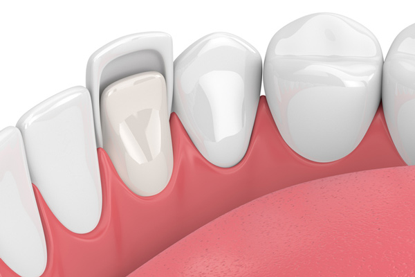 3D Rendering of teeth with a ceramic veneer from San Francisco Dental Arts in San Francisco, CA