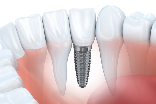 Diagram of dental implant in lower jaw from San Francisco Dental Arts in San Francisco, CA