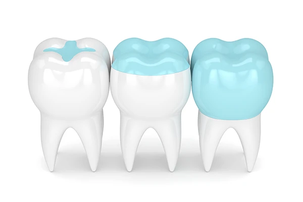 3D rendering of three teeth, one each with an inlay, onlay, and dental crown