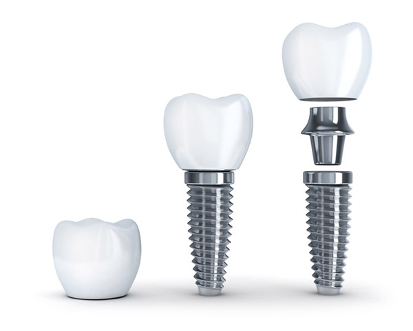 Diagram of a single tooth implant with post from San Francisco Dental Arts in San Francisco, CA