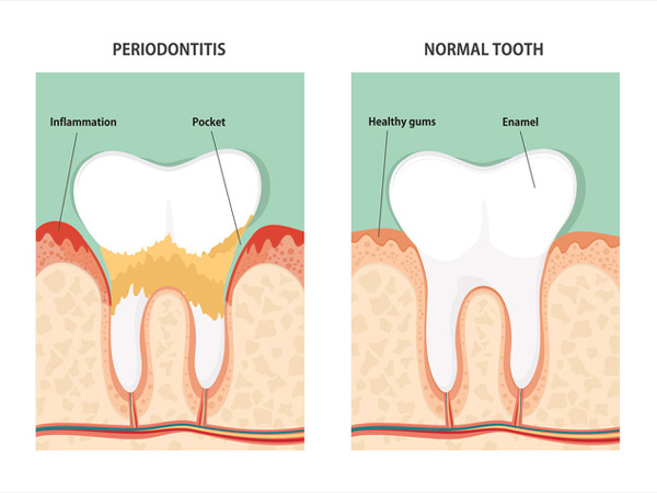 Diagram of periodontitis and health tooth