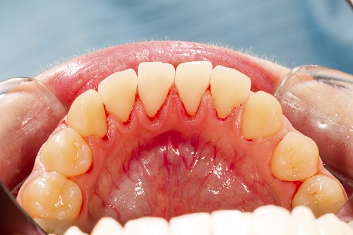 Different Gingival Biotypes