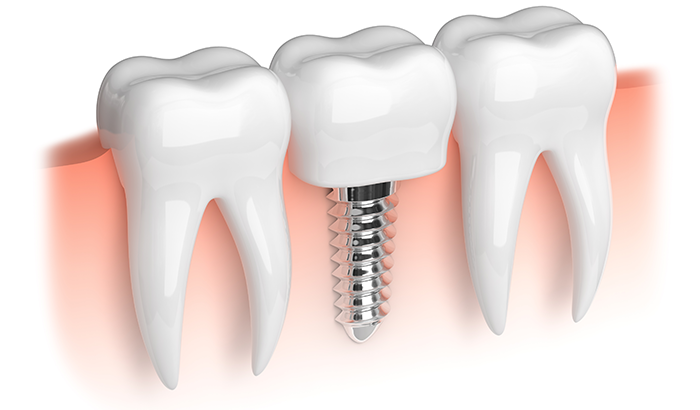 a 3D rendering of a dental implant
